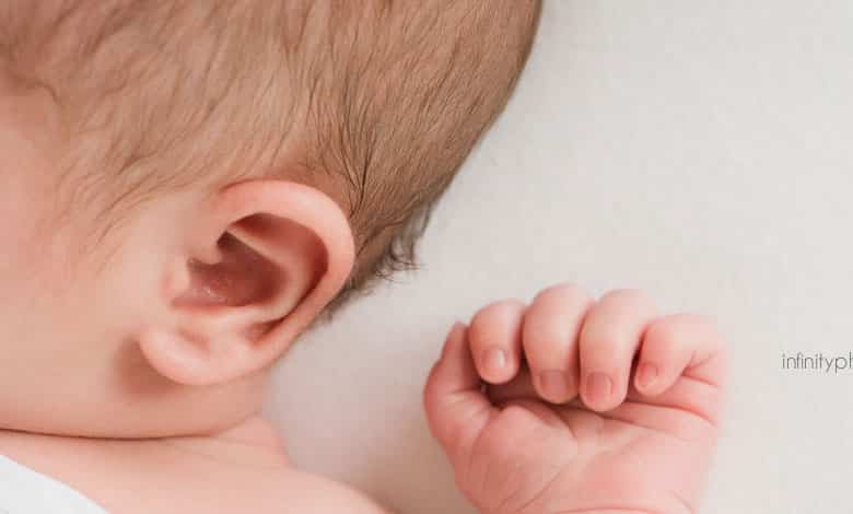 رفع کیپی گوش در کودکان و نوزادان